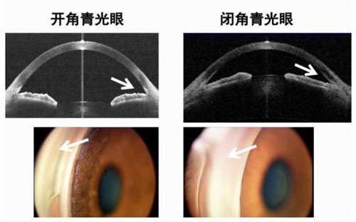 我国学者在闭角青光眼筛查与as-oct方面取得进展